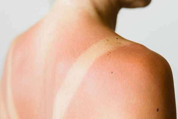 نکاتی برای مراقبت از پوست بعد از آفتاب سوختگی